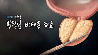 [명의 의학백과] 전립선 비대증 치료