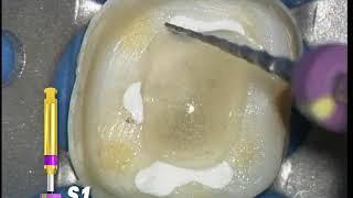 ProTaper Shaping Technique - Mandibular Molar: Case I