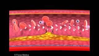 Atherosclerosis and thrombus formation - Heart