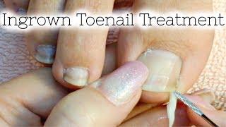 Pedicure Tutorial Ingrown Toenail Treatment At Home How to Recut Nail Groove to Eliminate Pain