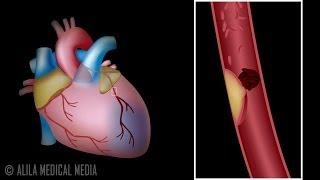 Myocardial Infarction and Coronary Angioplasty Treatment, Animation.