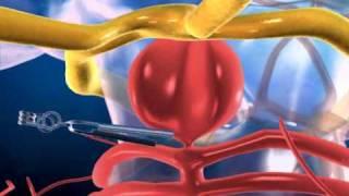 Aneurysm in the Brain and Clipping - 3D medical animation || ABP ©