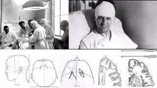 Maurice Ducosté   The inventor of lobotomy