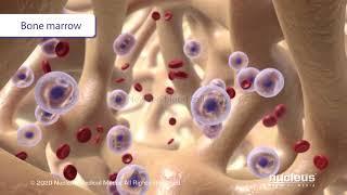 Anemia from Chronic Kidney Disease (CKD)