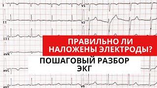 Разбор ЭКГ с неправильно наложенными электродами. Анализ ЭКГ.