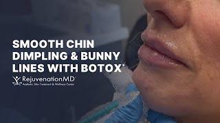 Botox for Chin Dimples and Bunny Lines