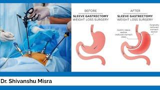 LAPAROSCOPIC SLEEVE GASTRECTOMY FOR MORBID OBESITY | DR SHIVANSHU MISRA