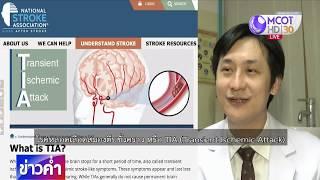 ชัวร์ก่อนแชร์ : สัญญาณเตือน 1 เดือนก่อนเป็นโรคหลอดเลือดสมอง จริงหรือ?