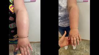 Результат лікування лімфедеми руки в АНГІОЛАЙФ