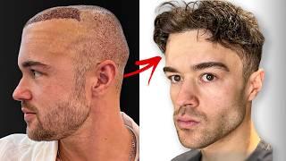 6 Month Hair Transplant Journey (Full Recovery)