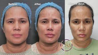 Combination filler and threads for improving face profile | Dr. Contessa Salvador-Alapag
