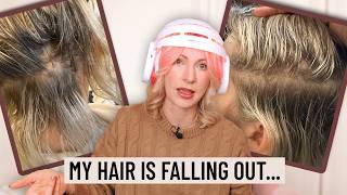 Why I’m Losing My Hair... (+ the Hair Growth Treatments I’m Trying)