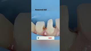 Tooth Filling v/s tooth Restoration | Case 24 | Your Dentist | #shots #shortvideo #shorts #short