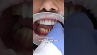 Get a PERFECT Smile with Veneers and Zirconium Crowns!