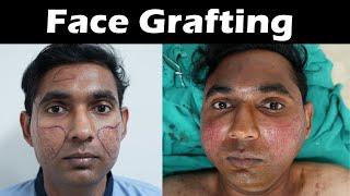 Face Fat transfer | Face Grafting