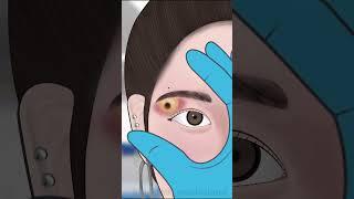 ASMR Infected Eyebrow piercing removal#asmr #animation #viral #trending #shorts