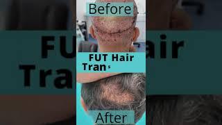 FUT Hair Transplant #shorst #ytshorts