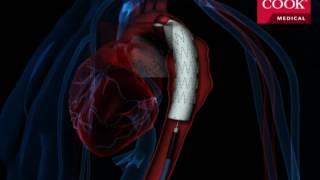 Thoracic Endovascular Aortic Repair (TEVAR)