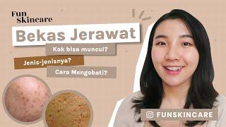 Skincare untuk Bekas Jerawat - PIH, PIE, Bopeng #skintalk