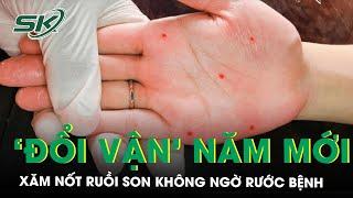 Xăm nốt ruồi son đổi vận: Vận chưa đổi đã rước thêm bệnh | SKĐS