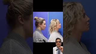 Neck Liposuction Before and After | Avance Plastic Surgery: Dr. Erez Dayan | Reno, Tahoe, NV