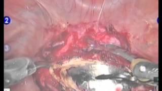 Robotic vesicovaginal fistula repair - Incise the vaginal cuff