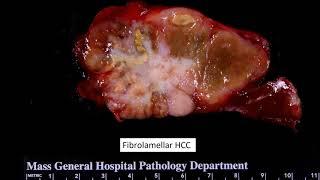 HCC histologic patterns