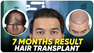 Hair Transplant in Iran | Best Results & Cost of Hair Transplant in Iran
