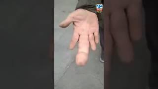 거대지증 걸린 손가락 ㄷㄷ