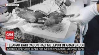 Telapak Kaki Calon Haji Melepuh di Arab Saudi