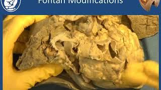 Fontan operation - Stephen Sanders, MD