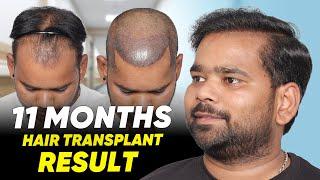 Hair Transplant in Bhopal | Best Results & Cost of Hair Transplant in Bhopal