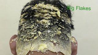 DRY SCALP !! Big Flakes Dandruff Scratching Satisfying Video #768