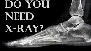 Is X-ray for your foot necessary? || Ottawa Ankle Rules ||