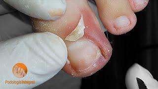 Ingrown toenail #podologiaintegral