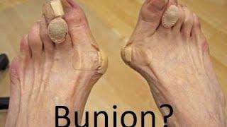 What Is A Bunion? *Complete Bunion Treatment Guide in 2 minutes*