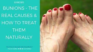 Bunions - the Real Causes & Natural Solutions