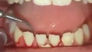 Full Mouth Debridement