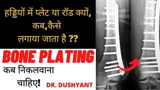 हड्डियों में प्लेट(रॉड) क्यों, कब और कैसे लगाया जाता है|| Plating In Bone Fracture |By Dr.Dushyant|