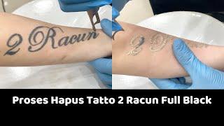 Proses Hapus Tatto 2 Rac*n | Laser Tatto Removal Indonesia