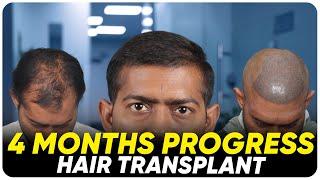 Hair Transplant in Pune | Best Results & Cost of Hair Transplant in Pune