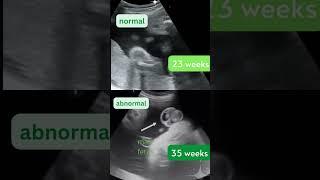 Ultrasound Showing Baby Boys  Normal v Abnormal Testicles | Gender Reveal #shorts