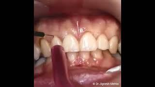 Gummy Smile Correction - Step By Step Procedure