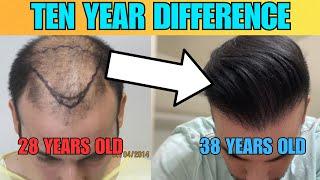 My Hair Transplant Journey 10 Years Later