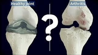 Knee Arthritis Treatments at Modern PT