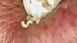 WOOW !! BEAUTY OF SQUEEZE BLACKHEADS REMOVAL FROM THE NOSE #2 #relaxing  #blackheads