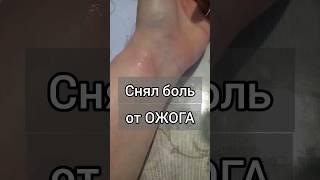 Первая помощь при ожогах в домашних условиях