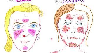 Acne Vulgaris Vs Acne Rosacea