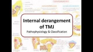 Internal Derangement of TMJ: Disc displacement with/without reduction & Wilkes classification