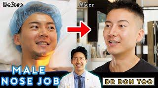 Male Nose Job Experience | Male Asian Rhinoplasty Surgery